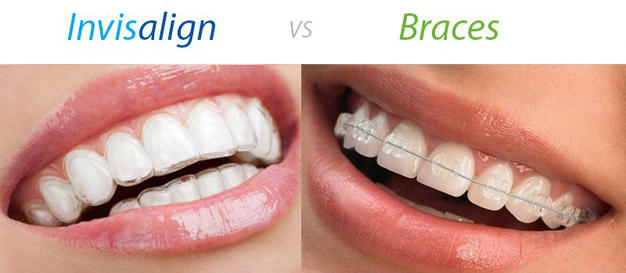 Invisalign átlátszó fogszabályozás